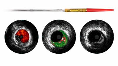 Catéter IVUS Eagle Eye Platinum ™ Short Tip Phillips (Volcano) Catéter IVUS Eagle Eye Platinum ™ Short Tip Phillips (Volcano) - Angioplastia Coronaria